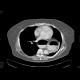 Diaphraghmatic hernia, Bochdalek hernia: CT - Computed tomography
